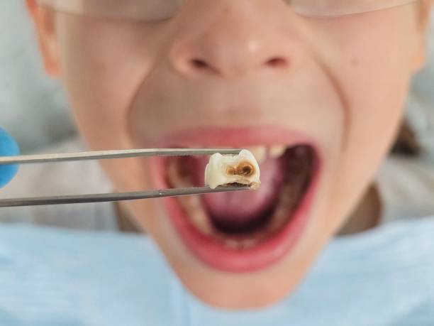 Best Emergency Treatment for Dental Infections or Abscesses in Cvallis, OR