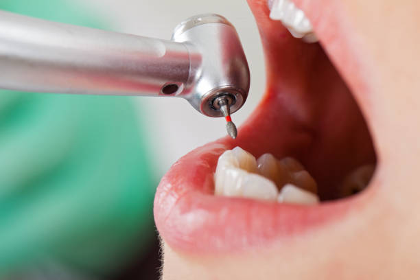 Best Emergency Wisdom Teeth Removal in Cvallis, OR